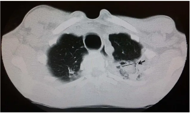 Figure 3 - Chest computed tomography showing a consolidation area in the posterior apical segment of the left  upper lobe, where a rounded shape lined by a small gas band can be observed, which is characteristic of the air  crescent sign (arrow), suggestiv