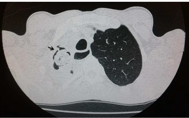 Figure  4  -  Chest  computed  tomography  showing  atelectasis  of  the  entire  right  upper  lobe  associated  with  bronchiectasis and interposed cavitations