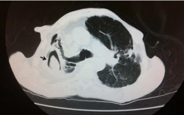 Figure 5 – Chest computed tomography showing important architectural destruction of the right upper lobe, with  deviation of the trachea and mediastinum, presence of bronchiectasis and cavitations, one of which has an oval  image bordered by a gaseous cont