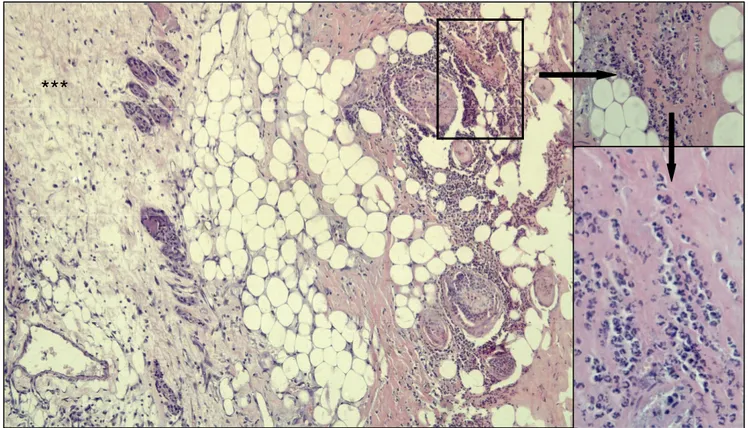 Figura  08  –  Fotomicrografia  de  corte  histológico  de  pele  murina  do  grupo  Controle  IP  evidenciando  área  de  granulação  (***),  com  a  presença  de  edema  e  células  inflamatórias  esparsas