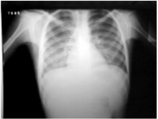 Figure 4. Chest x-ray (frontal view): micronodular infiltrate distributed uniformly in both lungs, showing the miliary pattern of primary tuberculosis.