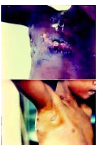 Figure 5. Chest x-ray (frontal view): calcified primary complex of tuberculosis in left lung, represented by Ghon focus on the edge of the lower third of the lung and satellite hilar adenopathy