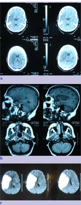 Fig. 1 - Caso 1: Oclusão da carótida interna direita. (a)TAC CE que mostra hiperdensidade espontânea da artéria cerebral média direita e extenso enfarte no território de distribuição da mesma
