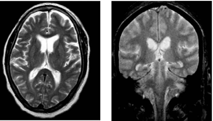 Figure 1. MRI of the encephalon does not reveal the presence of lesions.
