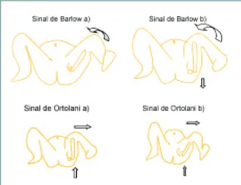 Figura 1. Manobras de Barlow e Ortolani Figura 2. Assimetria de pregas
