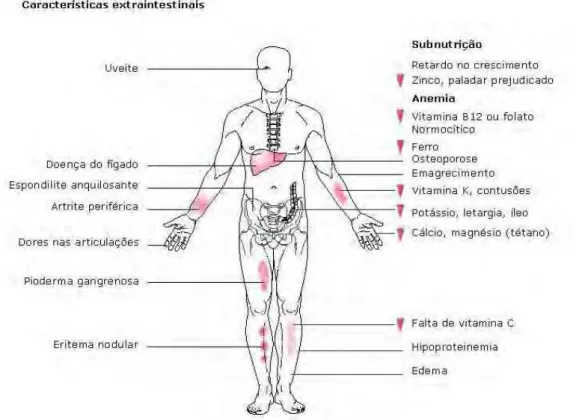 Figura 2. Algumas das complicações extraintestinais e características de  subnutrição encontradas em pacientes com Doença de Crohn (Misiewicz et al.,  1994)