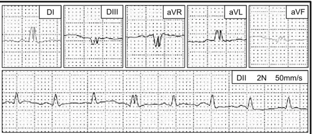 Figura 4.  Traçado eletrocardiográfico obtido de coelho do G1 no M2 durante  protocolo  de  indução  de  cardiomiopatia  por  doxorrubicina,  ilustrando  a  presença  de  distúrbio  de  condução  intraventricular  nas  derivações  bipolares  e  unipolares 