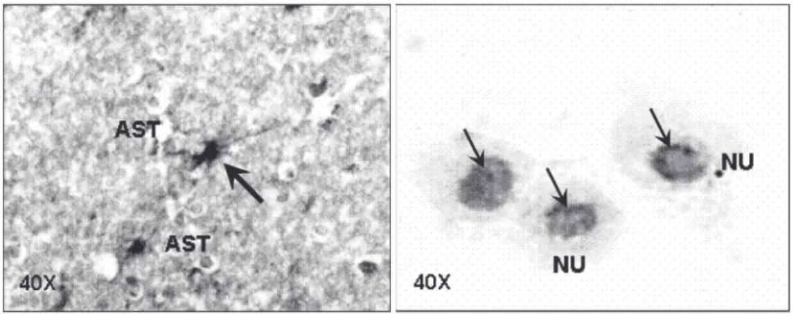Figure 3. Immunohistochemical reaction of astrocytes with the monoclonal antibody NOR-1 for p24 gag of human  T-lymphotro-pic virus type I
