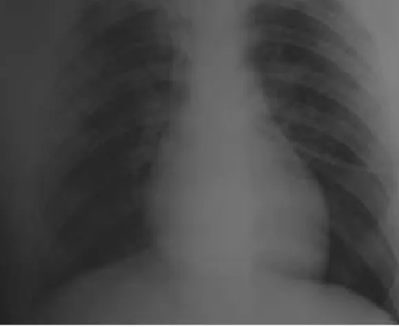 Fig. 1 – Radiografi a de tórax efectuada cerca de 30 minutos  após a instalação do quadro de insufi ciência  respiratória,  evidenciando um padrão de afectação alveolar difusa