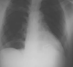 Fig. 3 – Radiografi a de tórax efectuada 12 horas depois: 