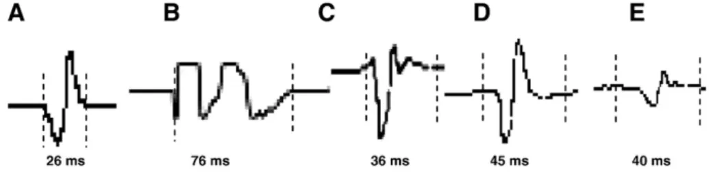 Fig. 3. Electrograms obtained from the right atrial appendage in a 72 years old woman with paroxysmal atrial ﬁbrillation