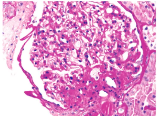 Figure 2. Obesity-related perihilar focal segmental glomerulo- glomerulo-sclerosis on a background of glomerulomegaly