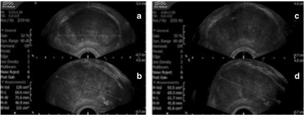 Fig. 8 Trans-rectal ultrasound. Prostate volume reduction after PAE. a, b Prostate volume before PAE (18 June 2009), 121 cm 3 