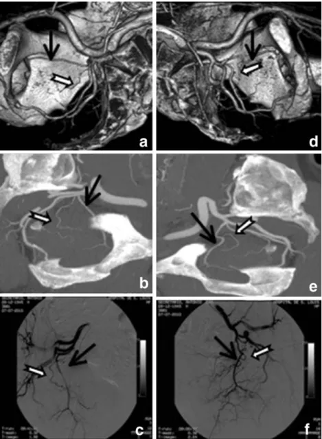 Fig. 1 Computed tomography angiography (CTA) and digital subtraction angiography (DSA) of internal iliac arteries (IIA) to show the origin of prostatic  ar-teries