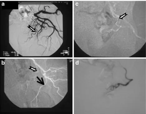 Fig. 2 Catheterisation of prostatic artery. a Digital subtraction angiography (DSA) of the left internal iliac artery (IIA)