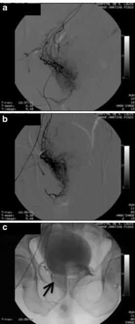 Fig. 3 Digital subtraction angiography (DSA) of the right prostatic artery, oblique and neutral views