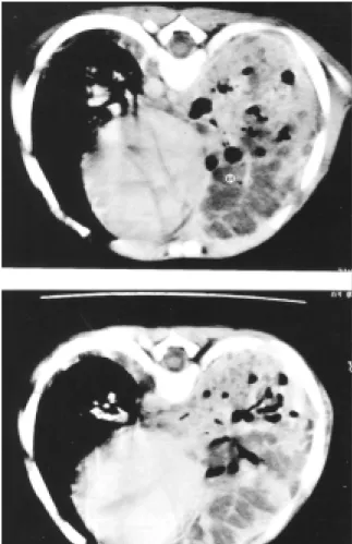 Figure 1. Chest radiography revealing hilar pneumonia. Figure 2. Chest computed tomography showing a large nodular image.