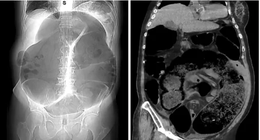 Fig. 1.  Colonic dilatation with bird beak  (left) and whirl sign (right).