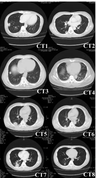 Fig. 1 – Chest CT images of pulmonary cryptococcosis. CT1 (patient No. 13) showing a mass with lobulation, short spikes and focal pleural adhesion and thickening in right lower lobe