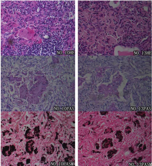 Fig. 2 – Pathological features of pulmonary cryptococcosis. Microscopic examinations of the pulmonary tissues of two patients (patients No