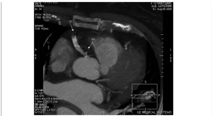 Figura 1. AngioTC: origem da artéria descendente anterior no ostio da artéria coronária direita com estenose proximal 