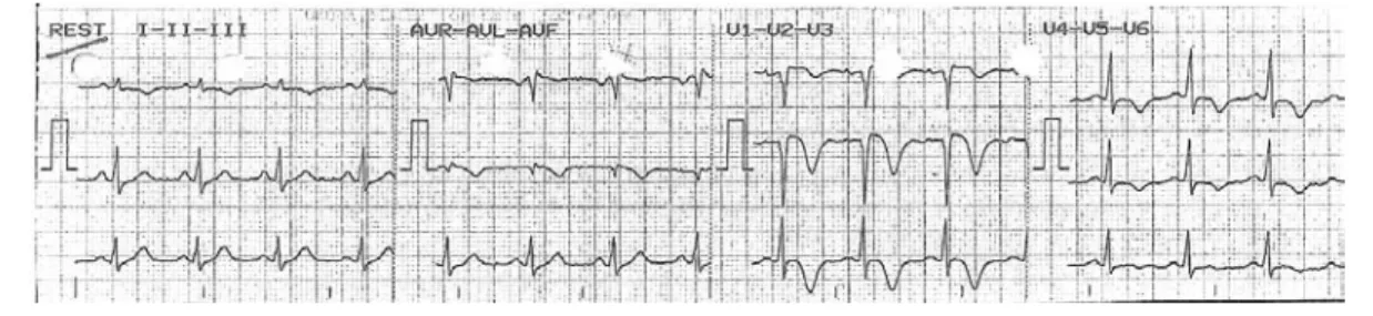 Fig. 1 Inversão da onda T em V1-V4 Fig. 1 T-wave inversion in V1-V4 Fig. 2 Supradesnivelamento do segmento ST em V1-V4 Fig