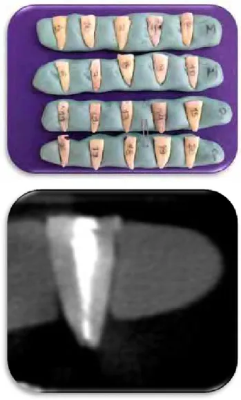 Figura 5 – Dentes posicionados no molde de silicone de condensação; Análise  tomográfica da área total de material obturador