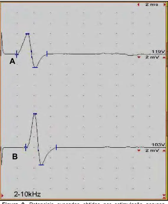 Figura 9. Potenciais evocados obtidos por estimulação nervosa  motora do nervo ulnar, após estímulo proximal (A) e distal  (B)