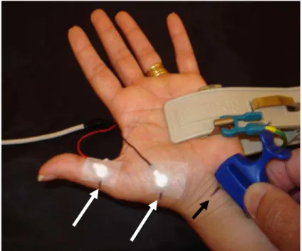 Figura 2  – Exemplo de condução nervosa motora do nervo mediano. Eletrodos captadores (de  superfície)  posicionados  no  ventre  (G1)  e tendão  (G2)  do  músculo  abdutor  curto  do  polegar  (setas  brancas)