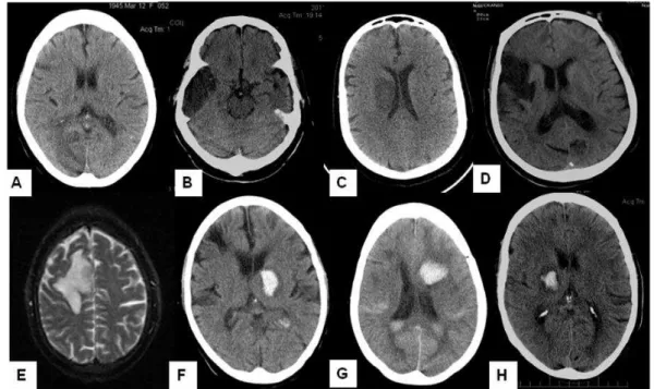 Figura 3 - Exemplos de lesões isquêmicas (A  – Paciente 2; B – Paciente 3; C – Paciente 6; D –  Paciente 8) e hemorrágicas (E  – Paciente 5; F – Paciente 13; G – Paciente 14; H – Paciente 17)