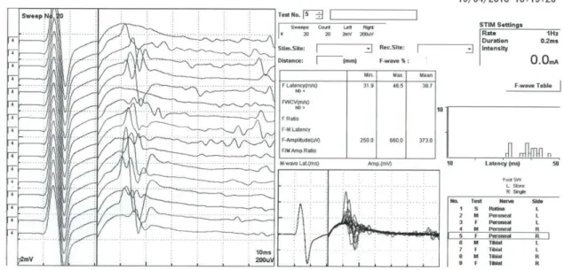 Figura 6 - Exemplos de persistências de ondas F normais (Paciente 9, PF = 87,5 %). 