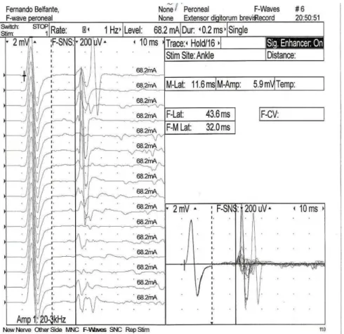 Figura 8  – Exemplos de persistências de ondas F aumentadas (Paciente 18, PF =  100%)