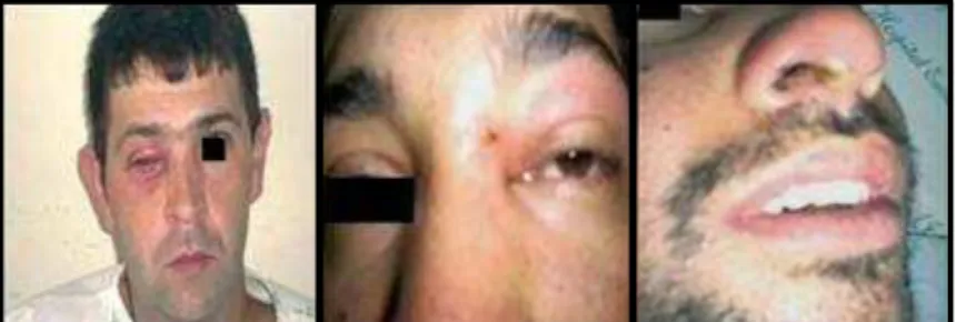 Figura 8: Lesão em vestíbulo nasal, periorbitária e intraorbitária em ordenhadores  infectados com VACV na região de Itajubá/MG
