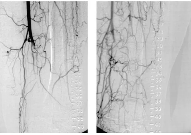 Fig. 4 – Á esquerda: Angiografia típica de Doença de Buerger  com doença ao nível poplíteo e tibial, com vasos femorais normais