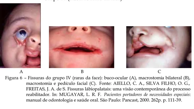 Figura 6  – Fissuras do grupo IV (raras da face): buco-ocular (A), macrostomia bilateral (B),  macrostomia e pedículo facial (C)