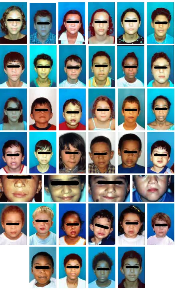 Figura 10 – Fotografias faciais de frente, dos 38 pacientes que compuseram a amostra  do presente trabalho de pesquisa (fissura pré-forame incisivo unilateral  completa)