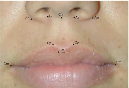 Figura 12 –  Fotografia de close do lábio com os pontos anatômicos demarcados. 