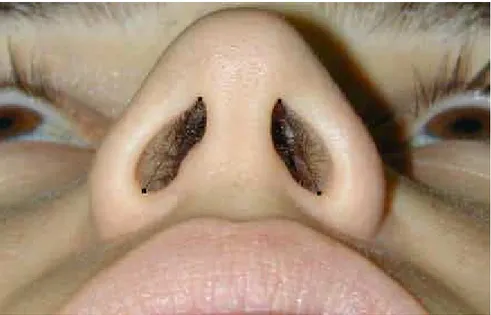 Figura 14 – Fotografia do ápice das narinas ao assoalho nasal para avaliação objetiva das  narinas (Na)