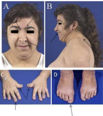 Figure 1 shows some clinical signs of one 23-year-old  RTS patient. The facial appearance is striking: bushy and  arched eyebrows, long eyelashes, downslanting palpebral  fissures, broad nasal brigde, beaked nose with the nasal  septum extending downwards,