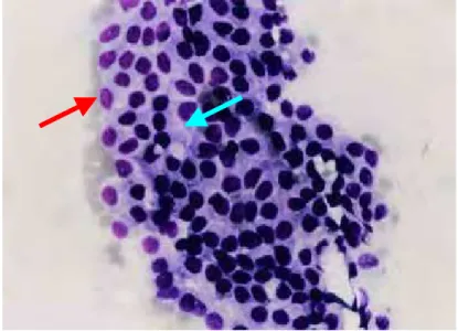 Figura 9 – Fotomicrografia de células prostáticas normais  obtidas por punção aspirativa e coradas com  Panótico rápido