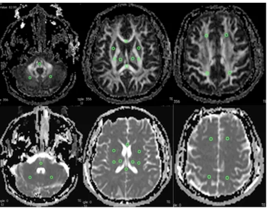 Fig. 1 Transverse FA and ADC maps show ROIs that were drawn bilaterally in brain parenchyma.