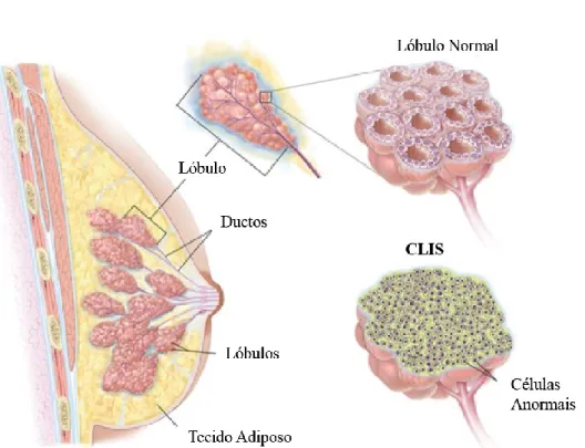 Figura 8: Carcinoma lobular in situ (CLIS) (adaptada de National Cancer Institute). 