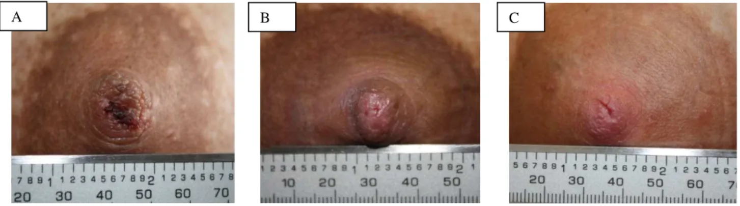 FIGURA 2.2 - Imagem representativa das lesões mamilares. 