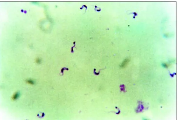 Figure 1. Trypomastigote forms of Trypanosoma cruzi in cerebrospinal fluid (Grunwald-Giemsa-stained smear;