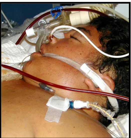 Figure 1. Chest X-ray showing diffuse pulmonary edema (A) in a severely ill septic patient with tiny purpuric rash on the trunk and face  (B); his amplified facial purpura (C)