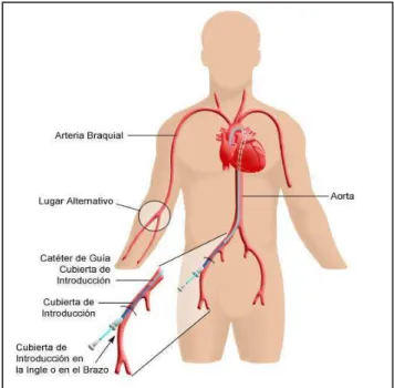 FIGURA 1 - Representação de uma arteriografia de  coronária esquerda 