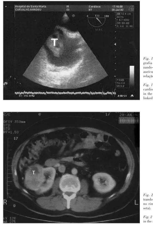 Fig. 1 Imagem de ecocardio- ecocardio-grafia transesofágica,  visuali-zando-se massa tumoral (T) na aurícula direita, com aparente relação com a veia cava inferior.