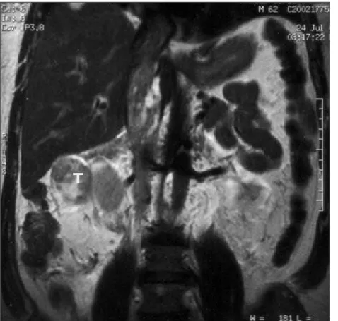 Fig. 3 Imagem de RMN onde se observa na veia cava inferior trombo tumoral intraluminal (indicado pela seta) ao longo de toda a sua extensão a montante da veia renal direita.