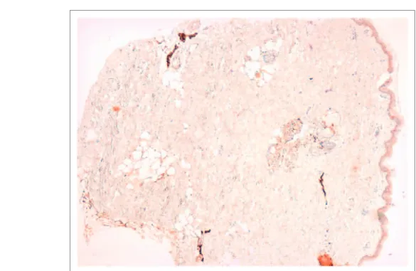 Figure 1 Skin section with normal dermal nerves (anti-PS100 antibody, peroxidase immunostaining in paraffin section  40).