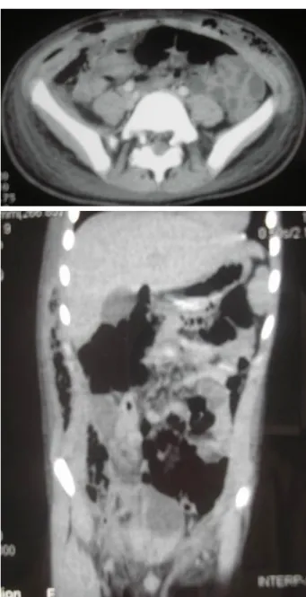 Fig. 2 - TAC tóraco-abdominal com marcado espessamento da parede  tóraco-abdominal e ar no tecido celular subcutâneo